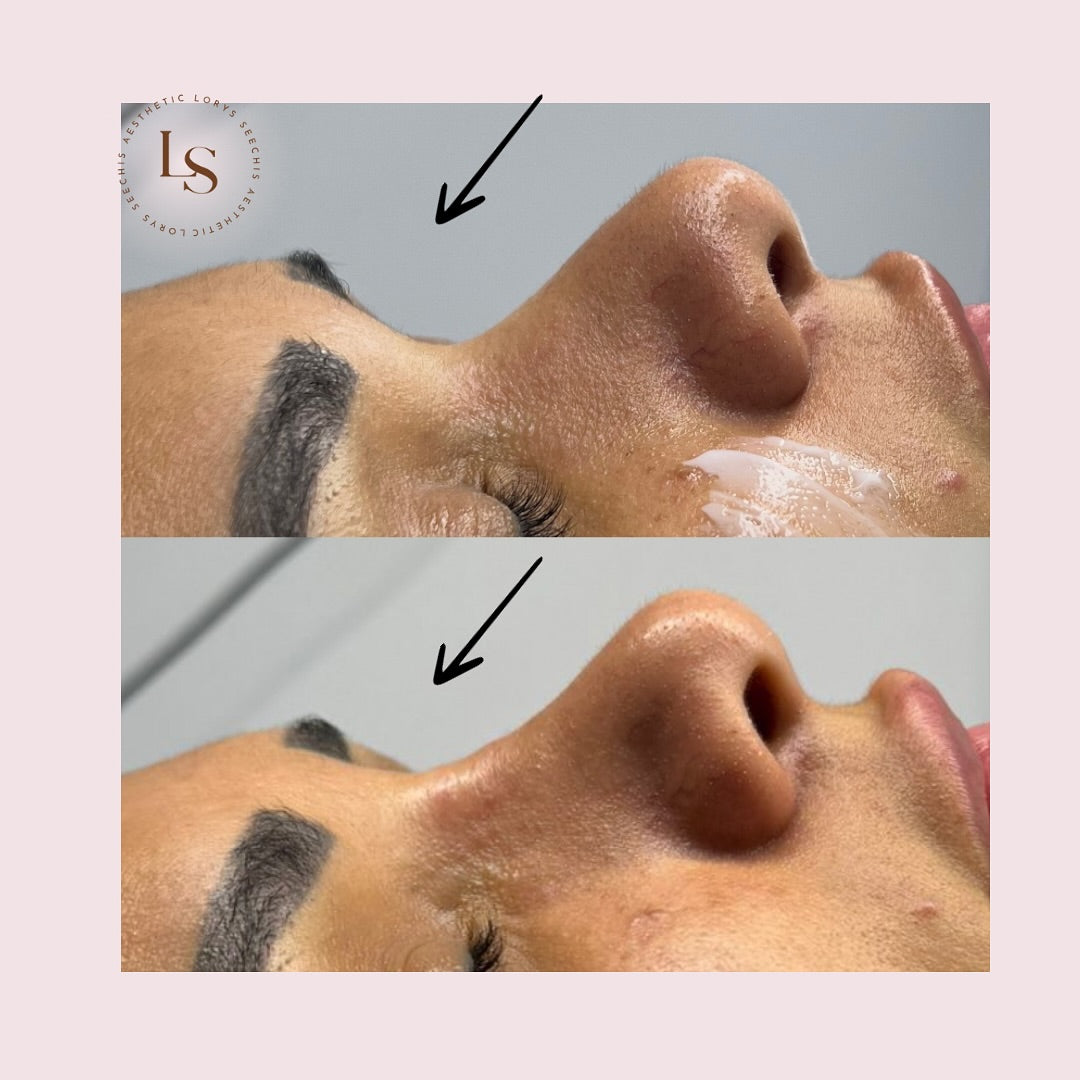 Non-Surgical Rhinoplasty