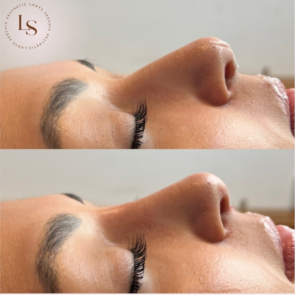 Non-Surgical Rhinoplasty