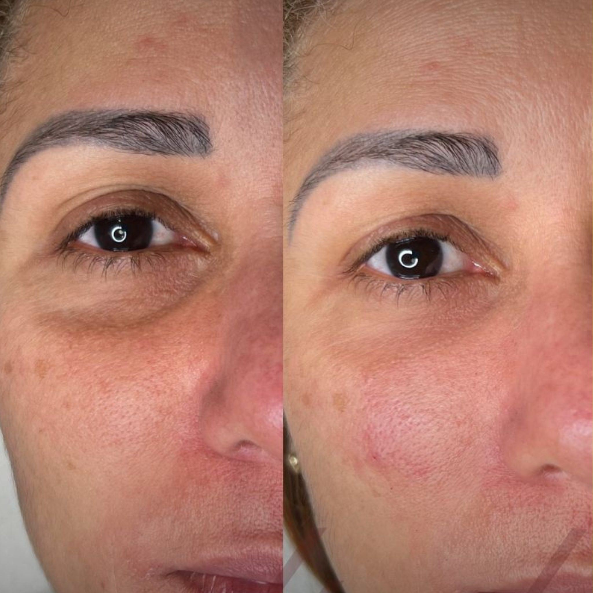 Tear Trough Fillers (Dark Circle)