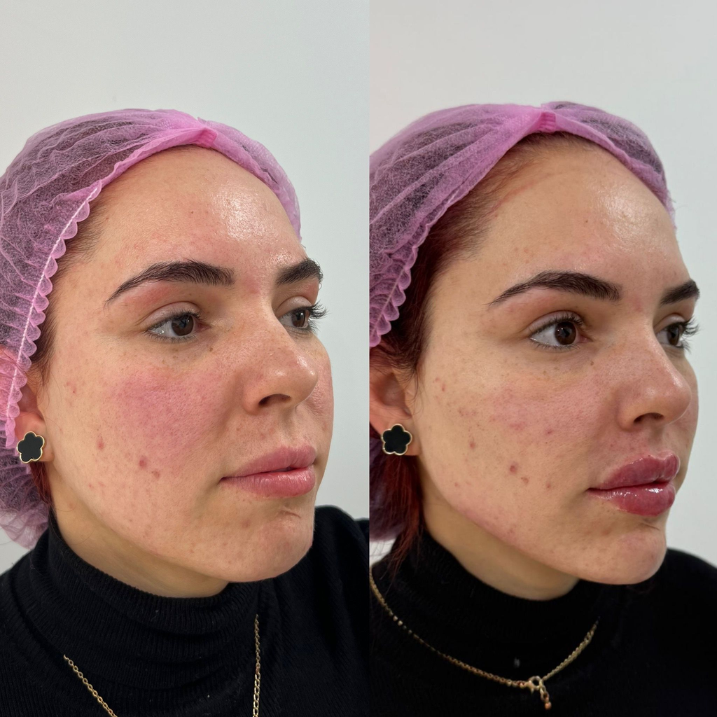 Facial Contour Package 6ml, 7ml & 8ml