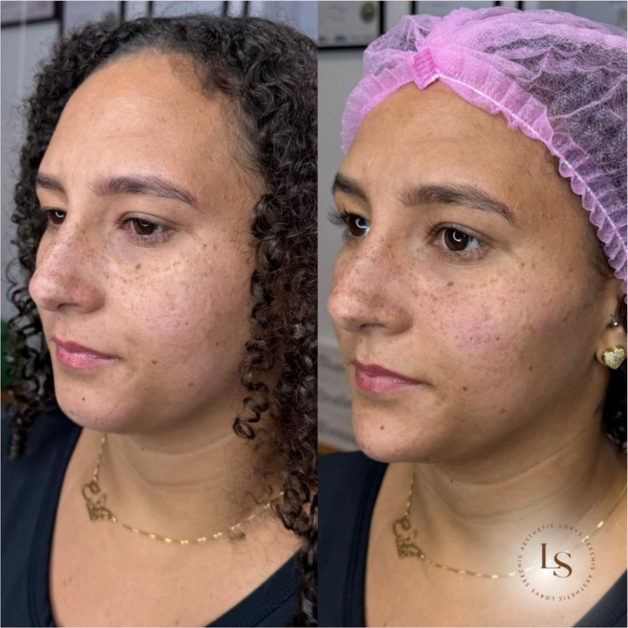 Facial Contour Package 6ml, 7ml & 8ml