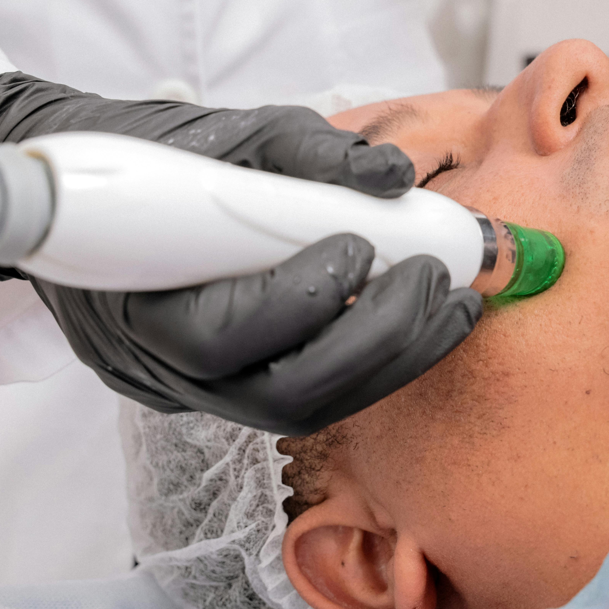 Lase Hair Removal - Full Beard