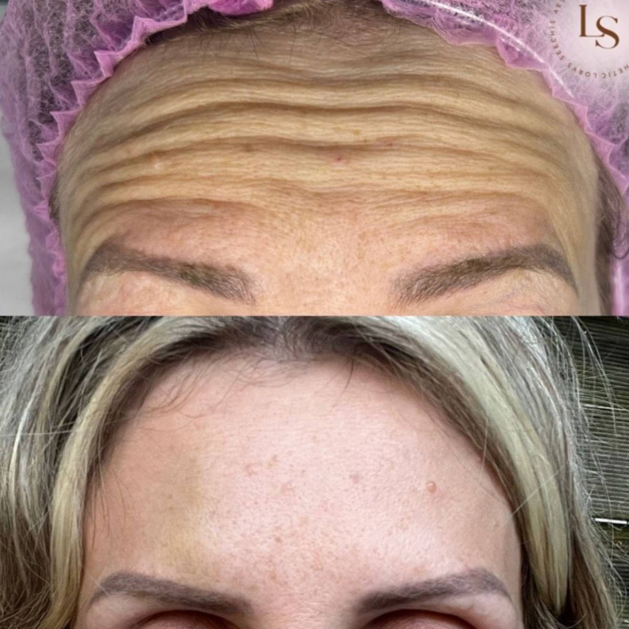 Anti-Wrinkle – 3 Areas + Brow Lift (Botox)