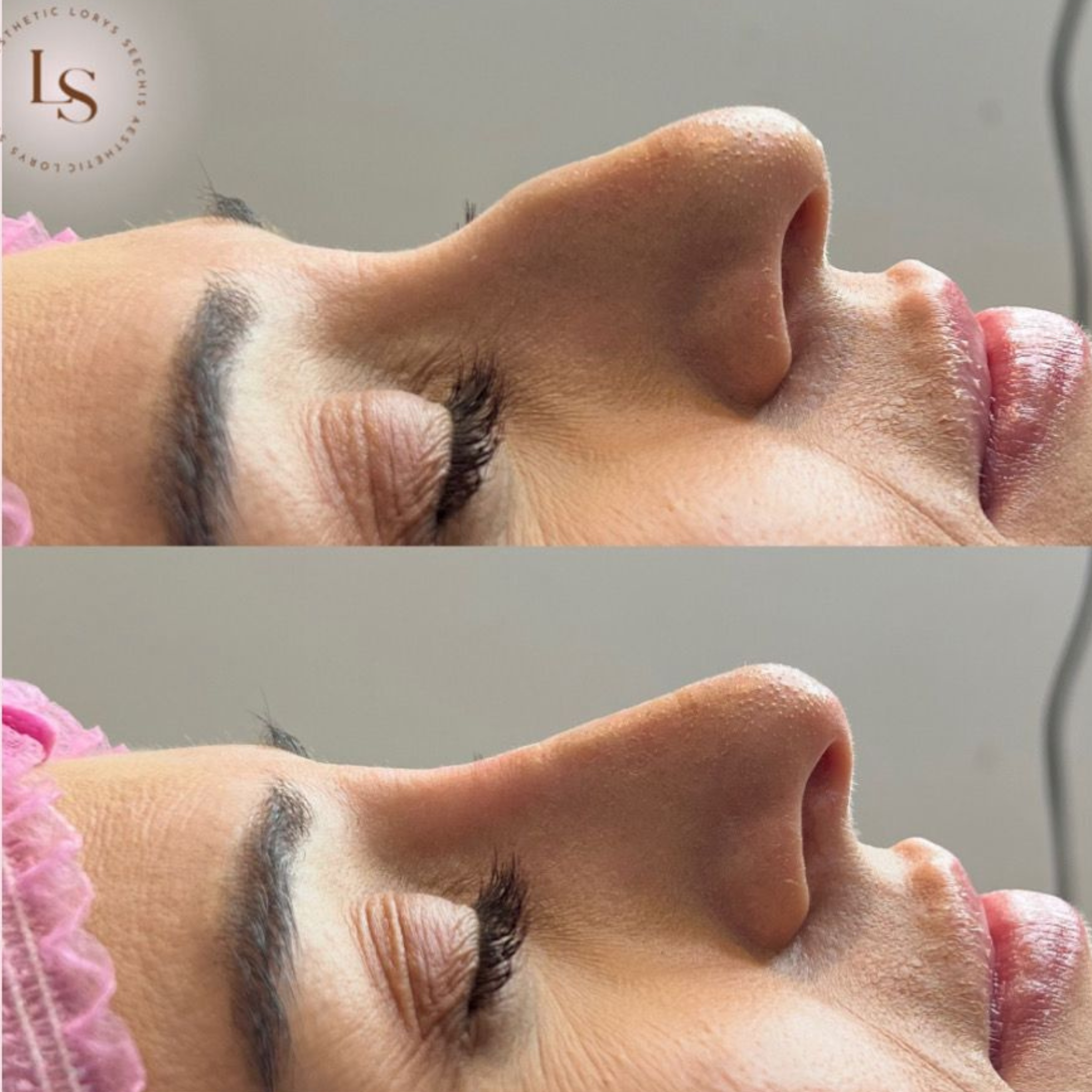 Non-Surgical Rhinoplasty