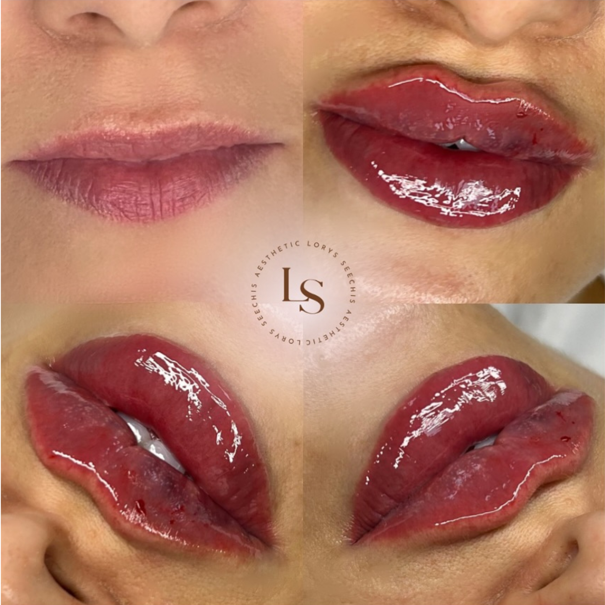 Russian Lips (lip augmentation)