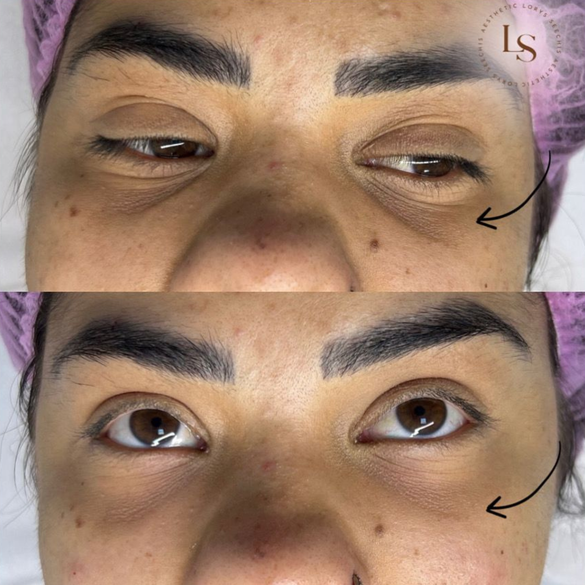 Tear Trough Fillers (Dark Circle)