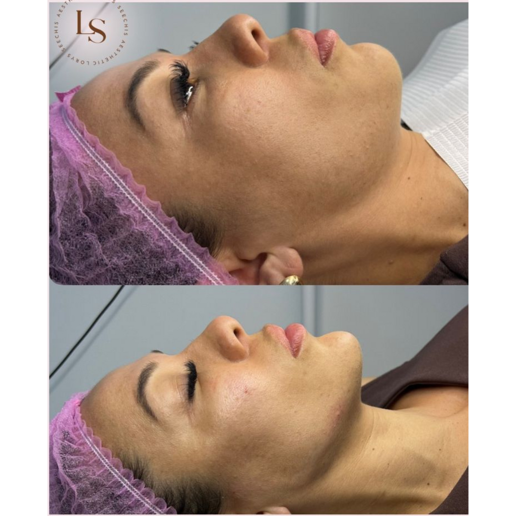 Facial Contour Package 6ml, 7ml & 8ml