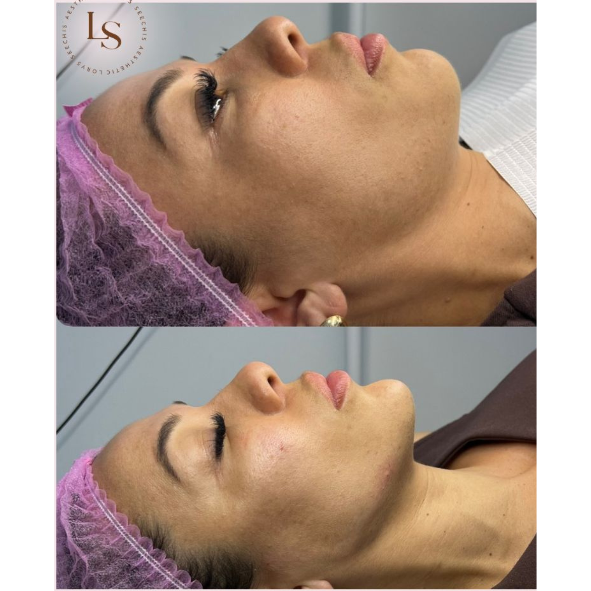 Facial Contour Package 6ml, 7ml & 8ml