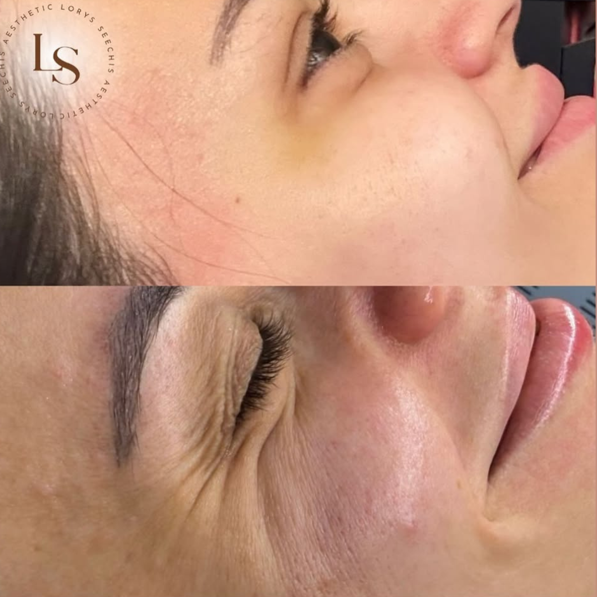 Anti-Wrinkle Injections 1, 2 or 3 Areas (Botox)