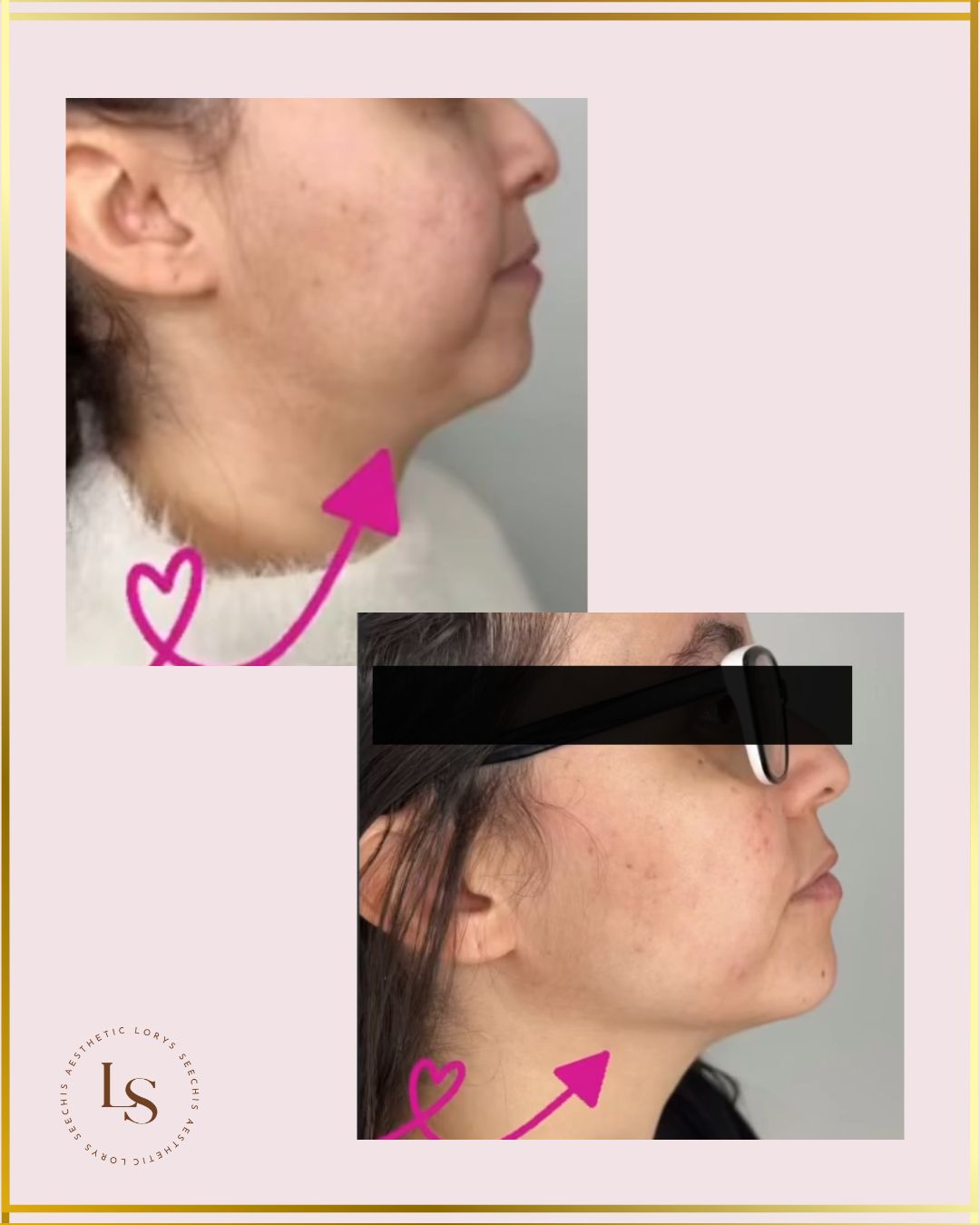 Fat Dissolving – Chin and Jawline