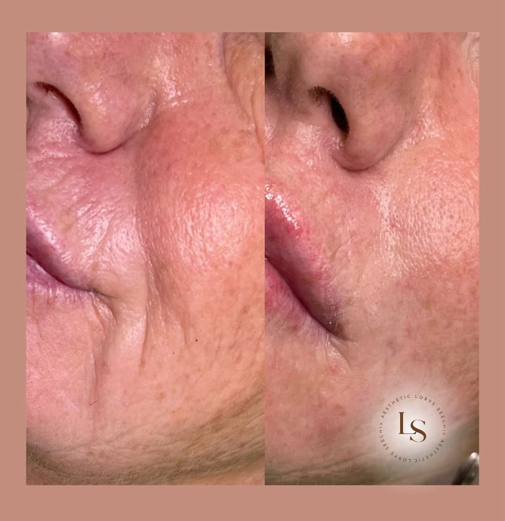 Nasolabial Folds (smile lines)