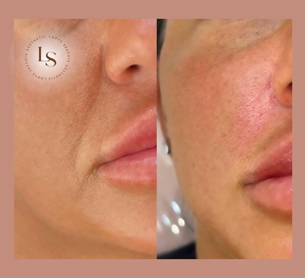 Nasolabial Folds (smile lines)