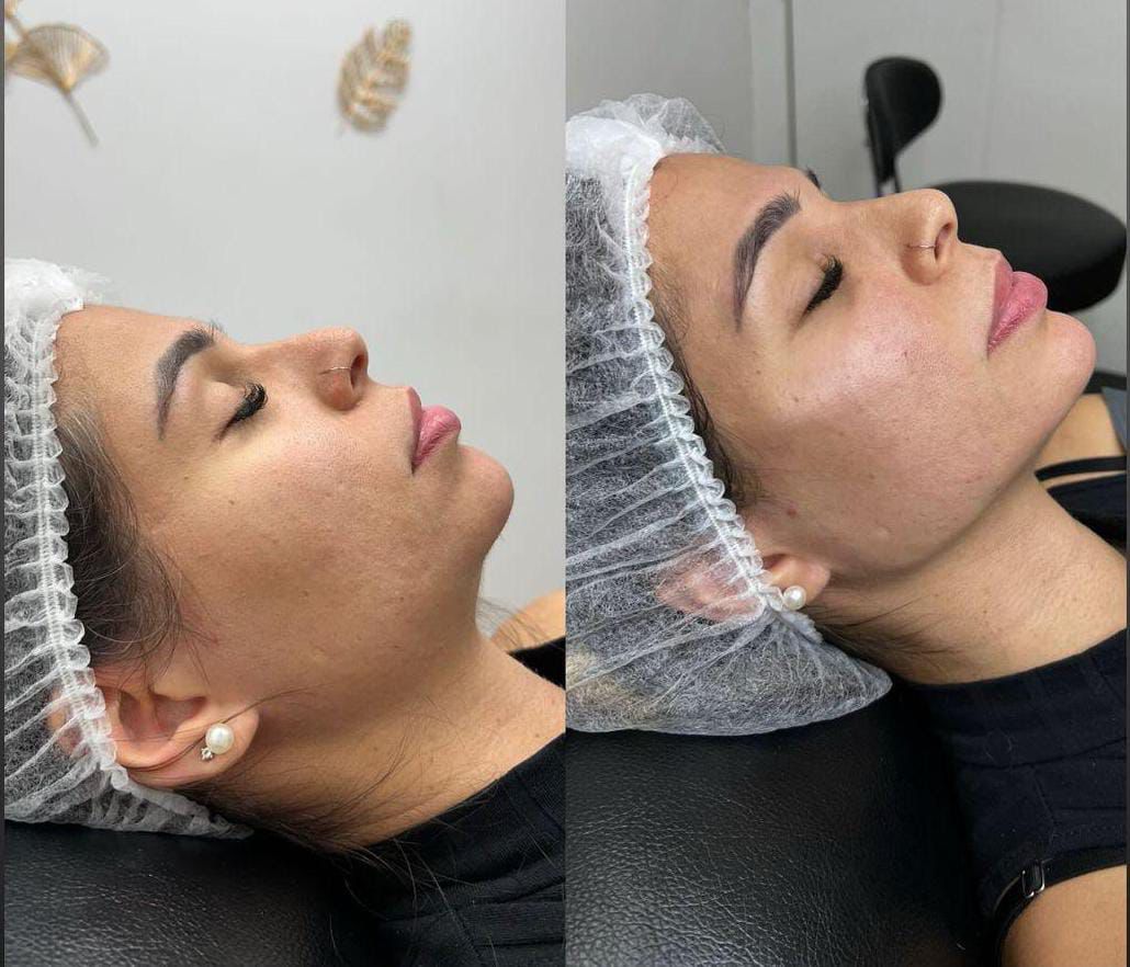 Facial Contour Package 3ml, 4ml & 5ml