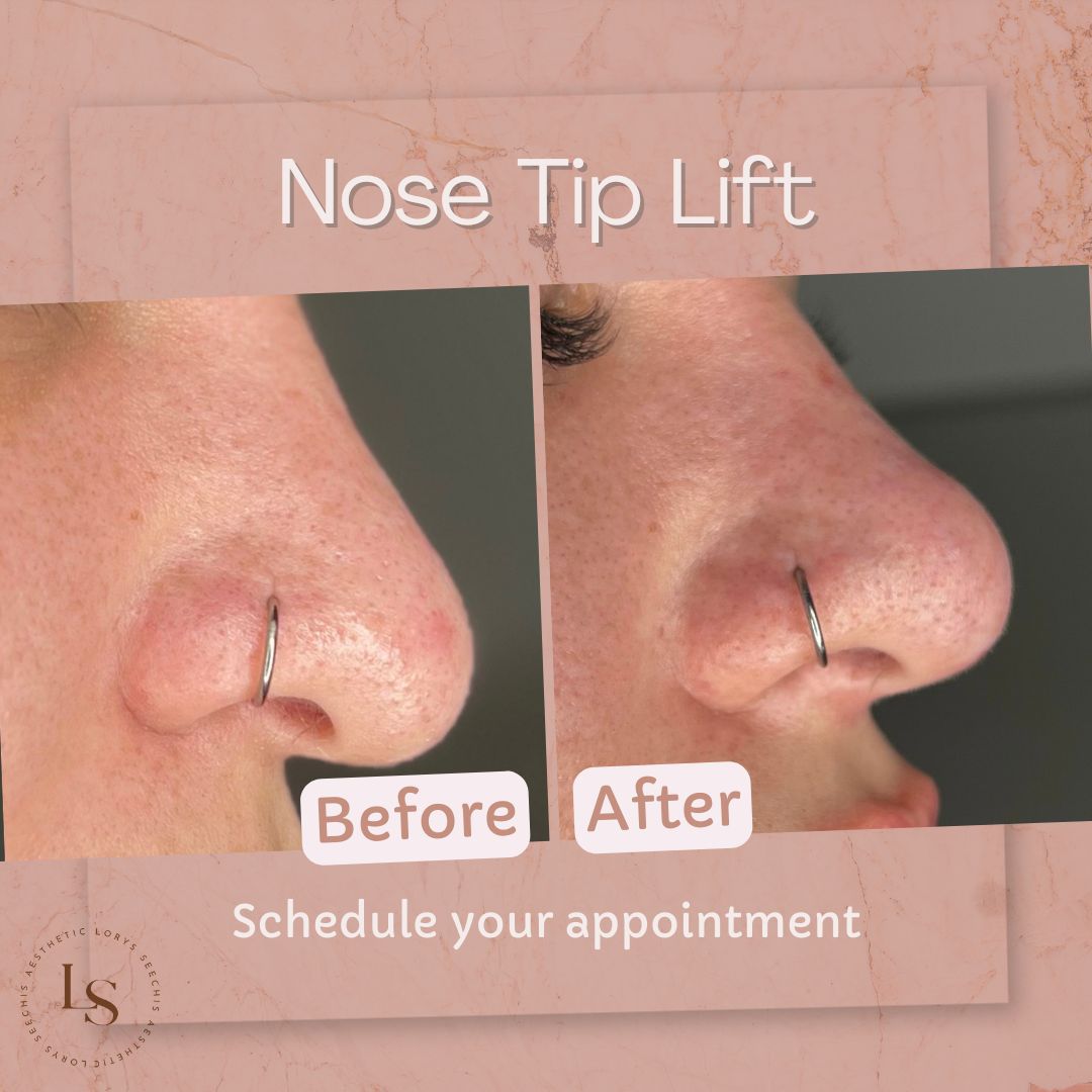 Nose Tip Lift