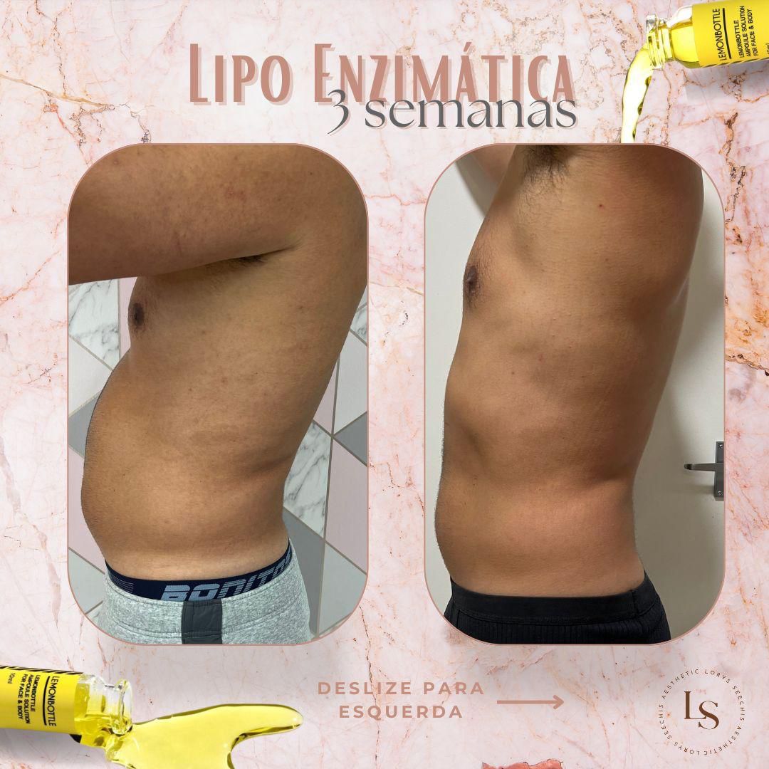 Fat Dissolving – Lower Stomach