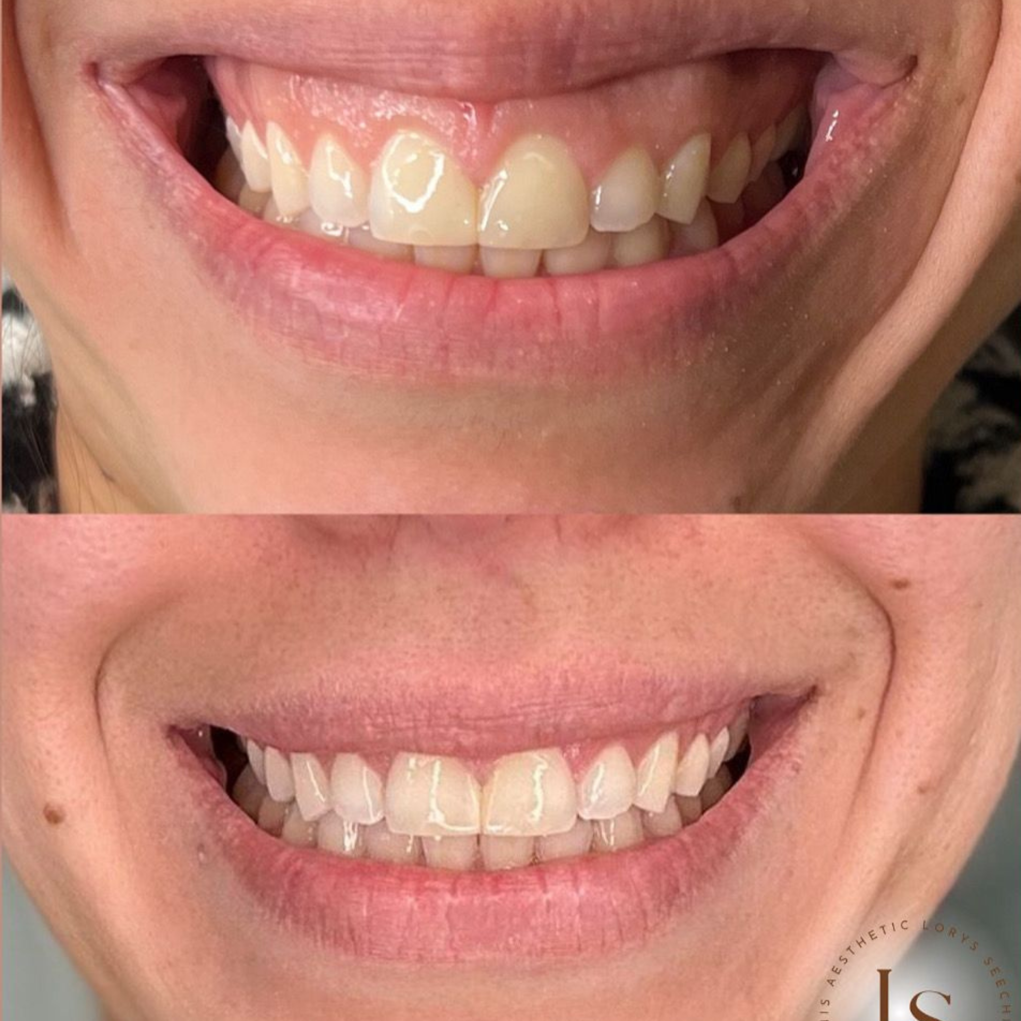 Gummy Lines (Gummy Smile Correction)