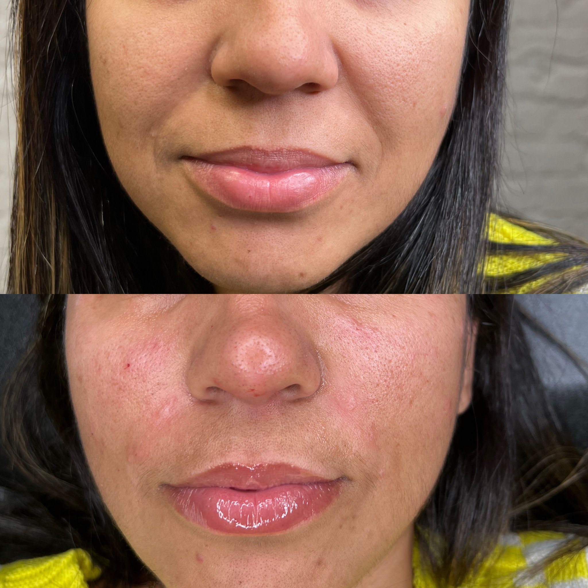 Nasolabial Folds (smile lines)